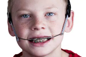 Anatomy of braces