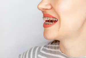 Bigstock braces in the smiling mouth of 403992710
