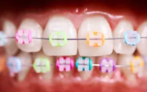Anatomy of braces