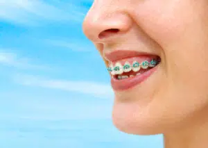 Bigstock turquoise braces 4253731