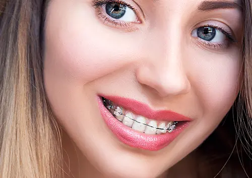 Clear braces3
