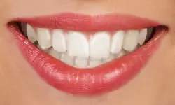Clear Aligners Invisalign
