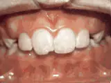 overjet before