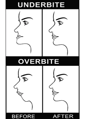 Underbite and overbite before and after | surgical orthodontics by gibbs ortho
