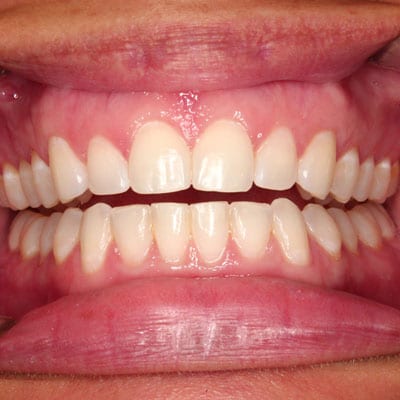 best invisalign front