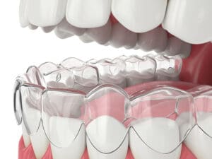 Illustration of an Invisalign clear aligner as placed over teeth