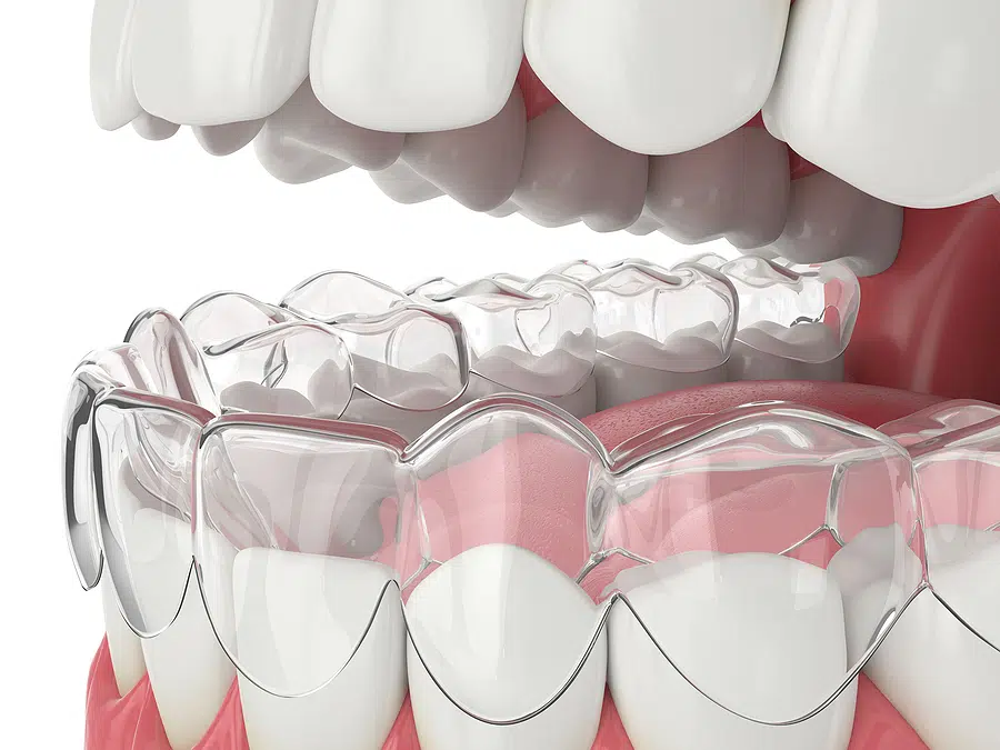 Questions to ask your orthodontist before getting invisalign