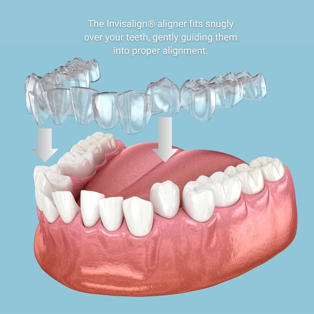Invisalign upper east side nyc