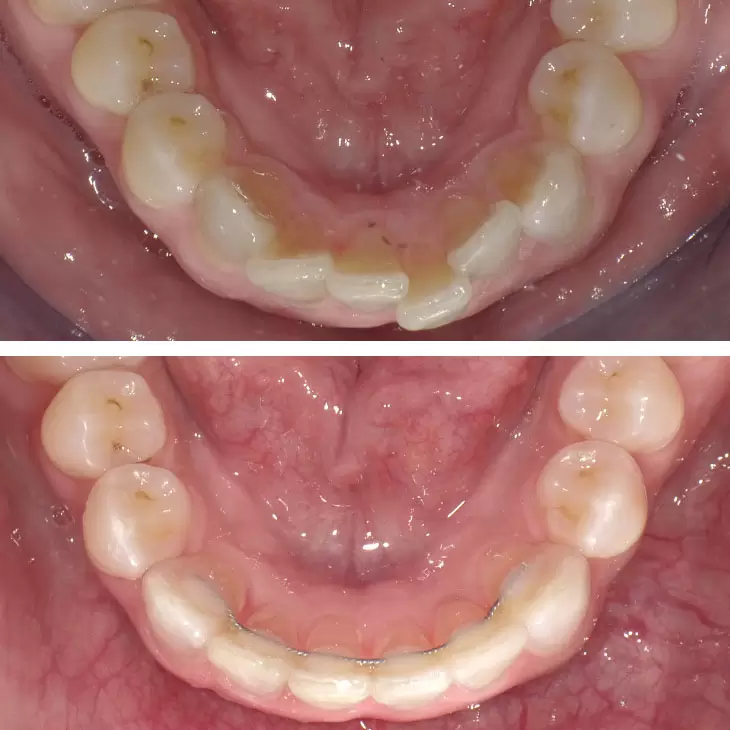Dental Retainers Gibbs Orthodontic Associates