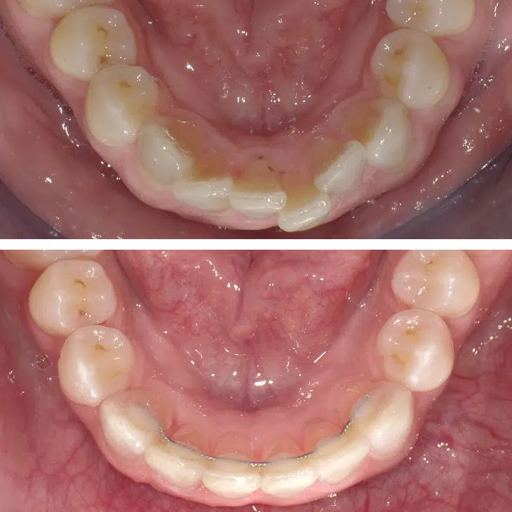 Orthodontic Retainer Specialists 2 Fixed retainers specialist nyc