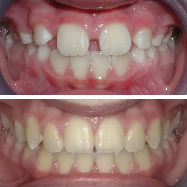 Invisalign Results - Before/After Invisalign Treatment