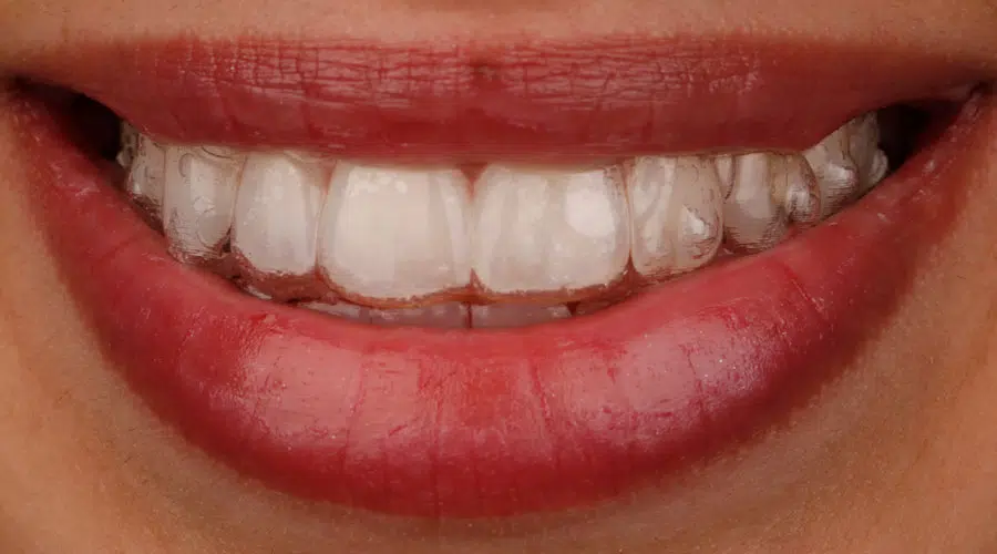 Invisalign Clear Aligners