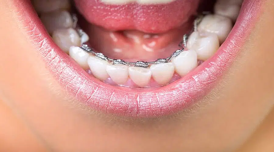 Dental Braces 6 Lingual braces