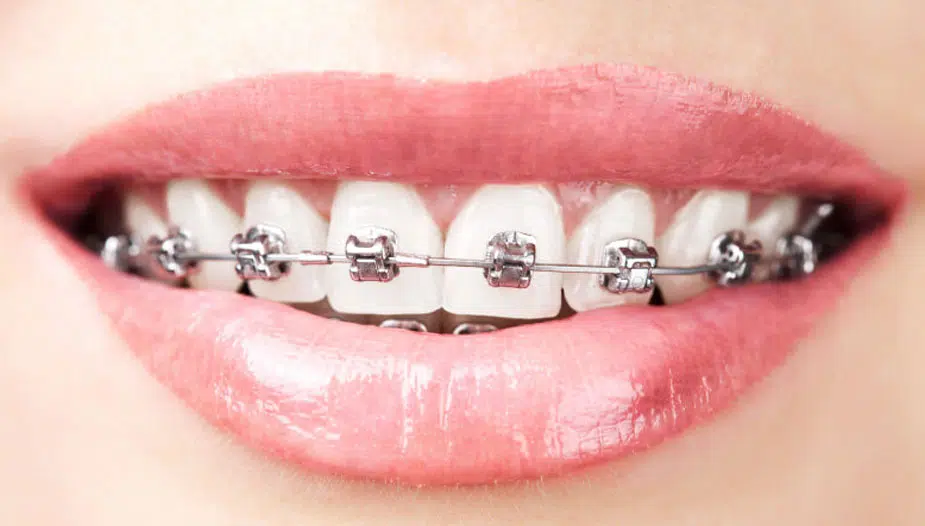 Self-ligating Braces