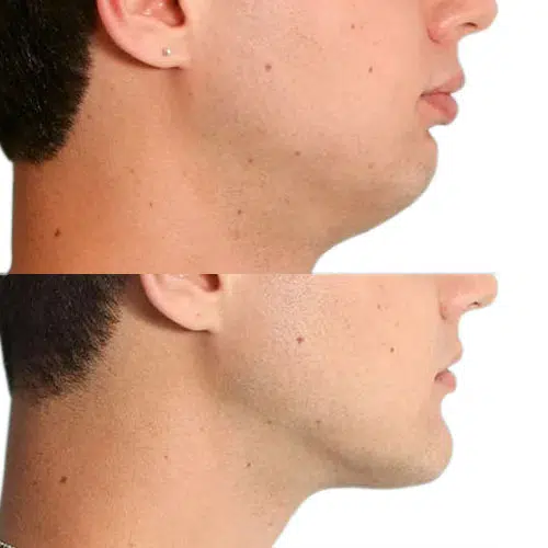 Surgical orthodontics, orthognathic before after overbite