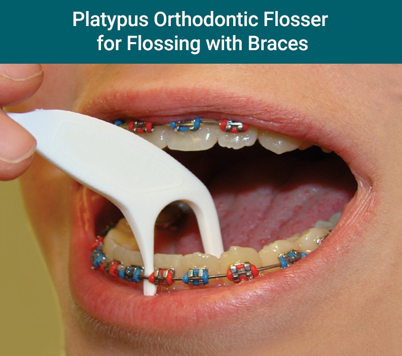 How to Floss With Braces Gibbs Orthodontic Associates