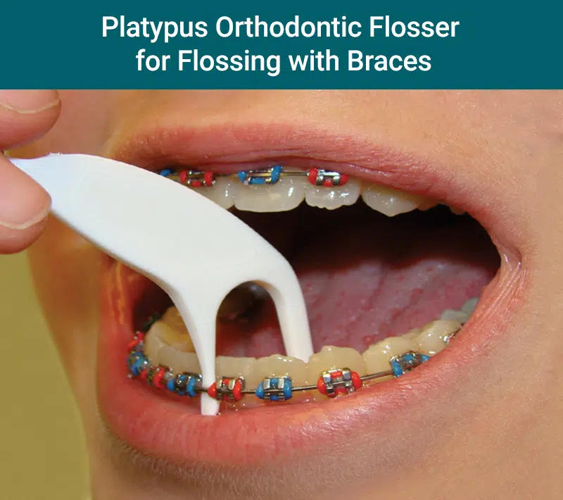Platypus orthodontic flosser for flossing with braces