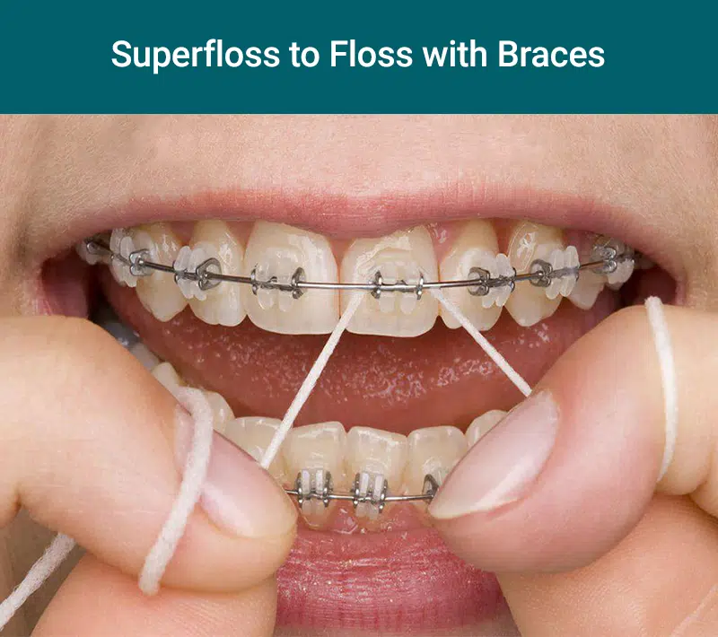 Superfloss to floss with braces