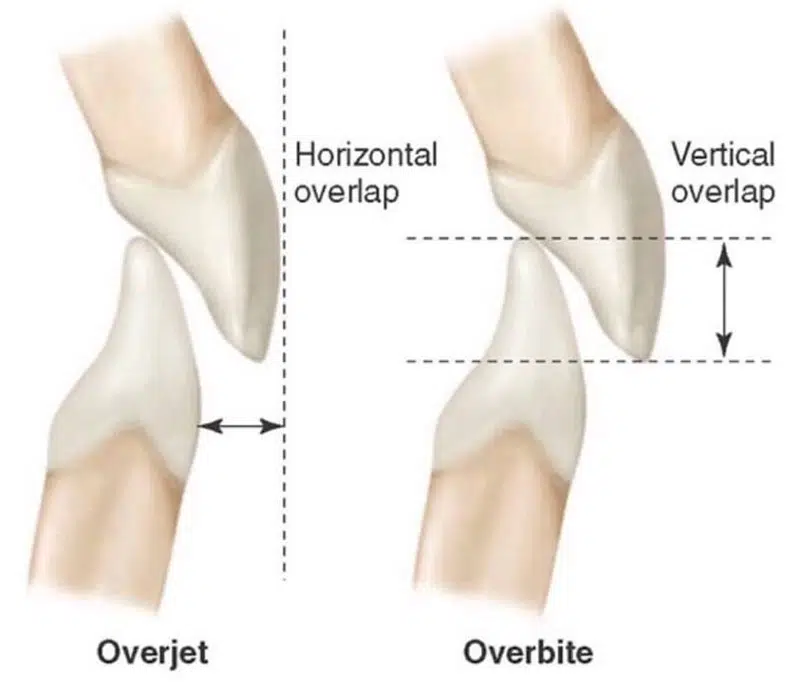 Types Of Overbite: Vertical And Horizontal Vertical horizontal overbite