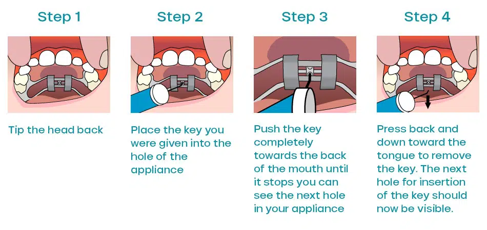 Adjusting a palatal expander step by step