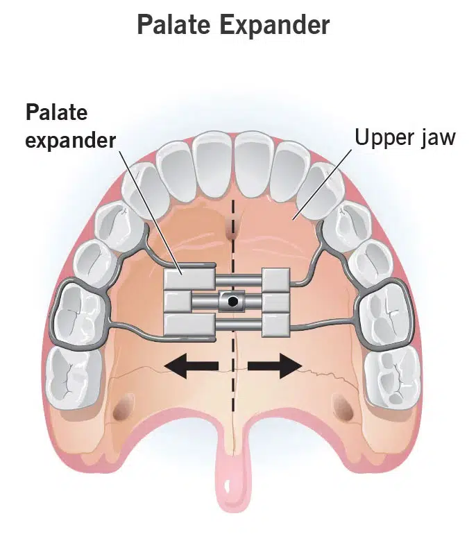 What Is An Orthodontic Expander &Amp; When Is It Necessary? 1 Orthodontic palate expander