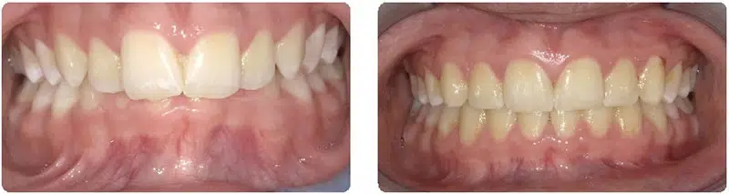 How To Fix An Overbite With Braces (How Long Does It Take?) 2 Overbite before after case 2