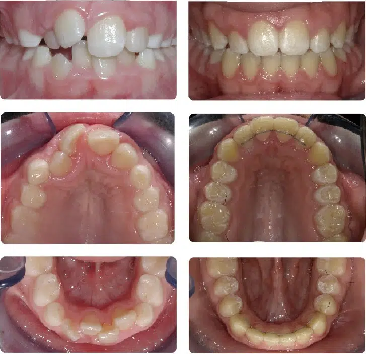 Overbite Correction Braces