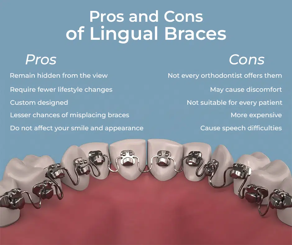 What To Know About Lingual Braces Gibbs Orthodontics What To Know About Lingual Braces Gibbs Orthodontics
