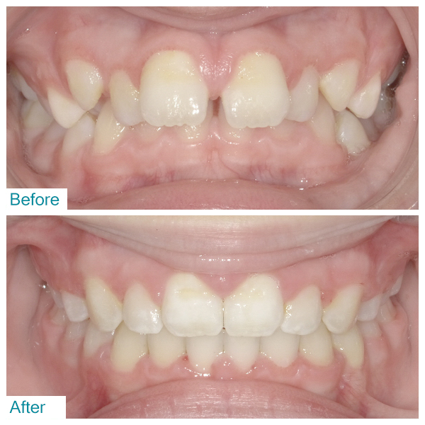 Before-After 1