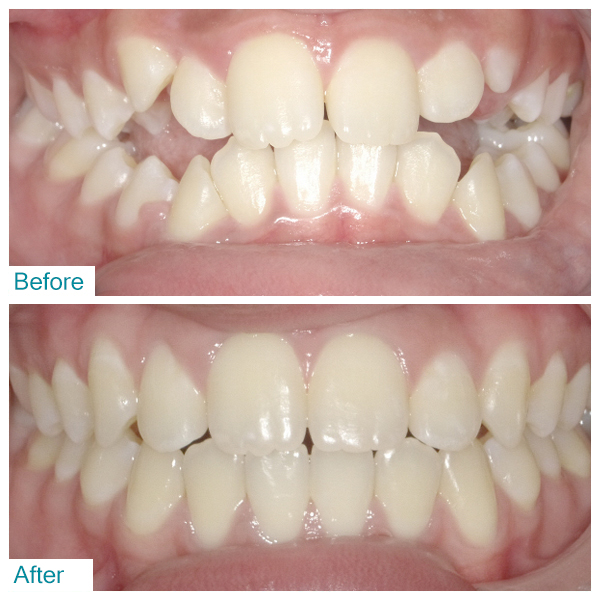 Before-After 3