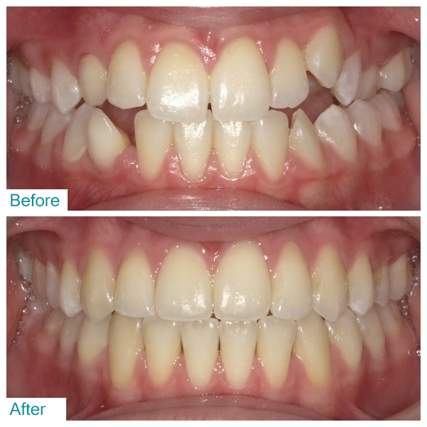 Before-After 4