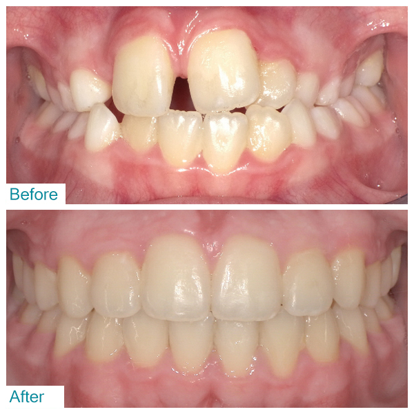 Before-After 5