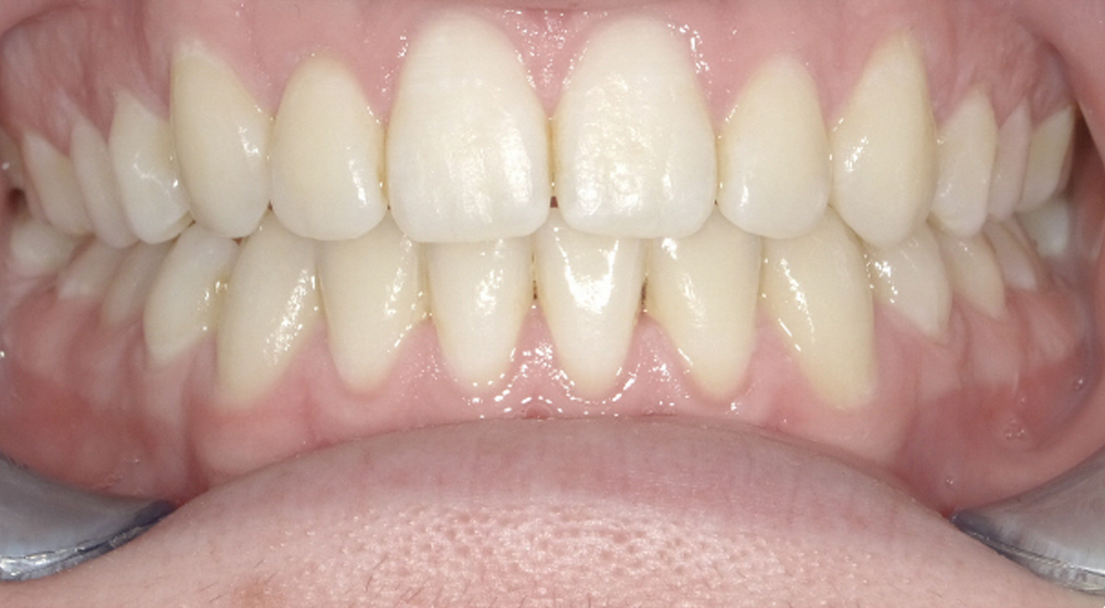 Before And After 26 After image