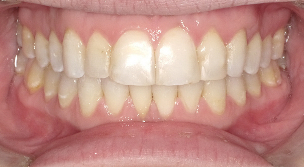 Before And After 28 After image