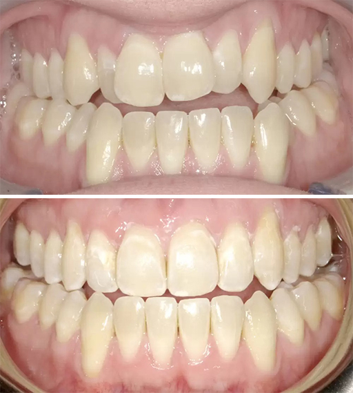 Invisalign before and after 1