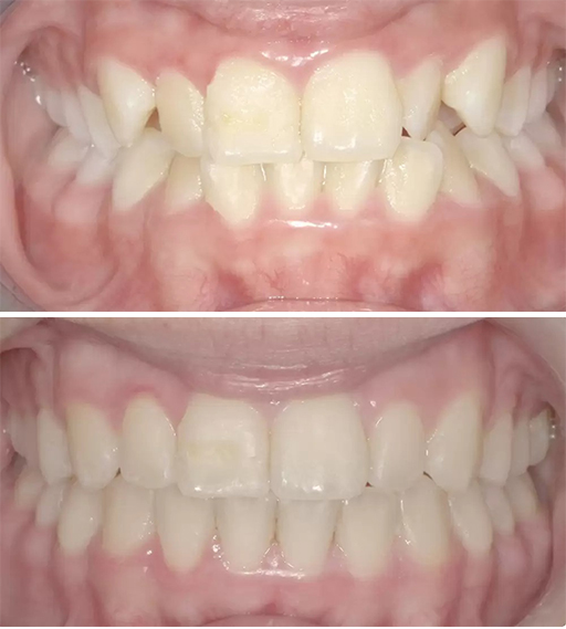 Invisalign before and after 2
