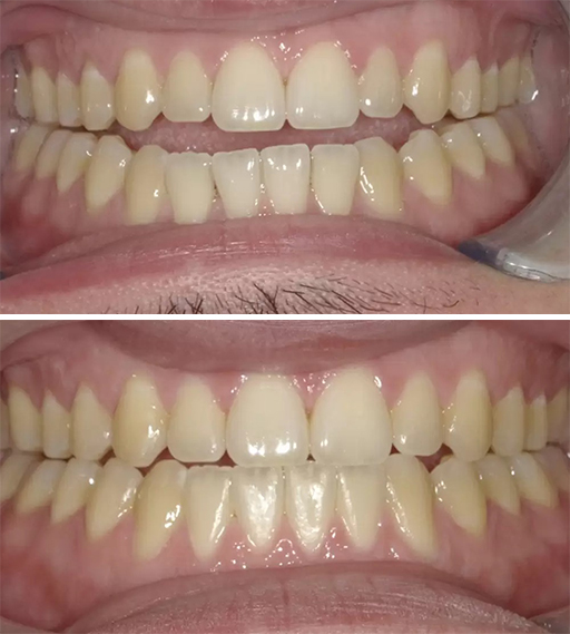 Invisalign before and after 3