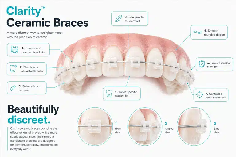 Clarity Ceramic Braces Upper East Side Orthodontist Gibbs Orthodontics