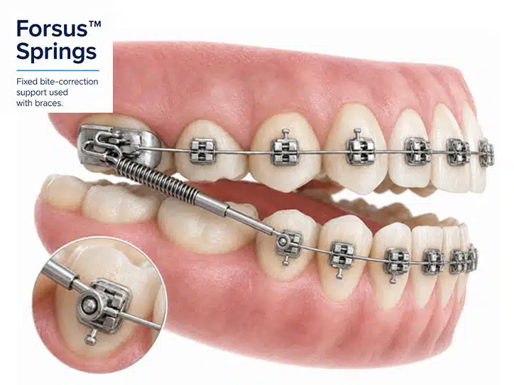 Illustration of Forsus Springs orthodontic appliance with braces, showing the upper molar spring and lower telescoping push rod used for overbite correction.